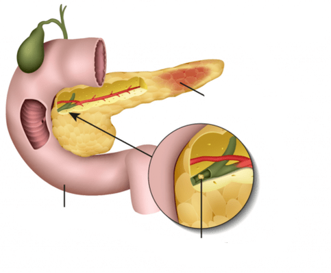 Pancreatita este inflamația pancreasului